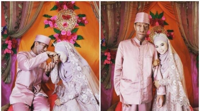 Bukti Cinta, Surya Manurung Pengidap Treacher Collins Syndrome Nikahi Gadis Cantik