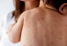 Pemkot Bogor Waspadai Penularan Campak